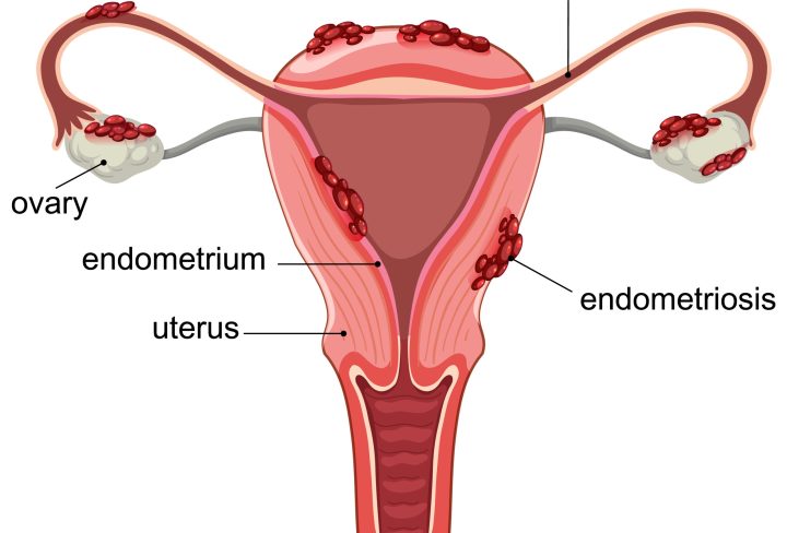 Vector illustration showing endometriosis in the uterus, highlighting ovaries, fallopian tubes, and endometrium with labeled parts